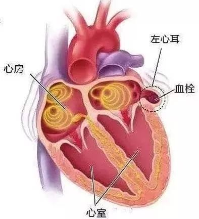 人到中年，如何避免腦梗死，做到三個(gè)堅(jiān)決，讓你生活更健康