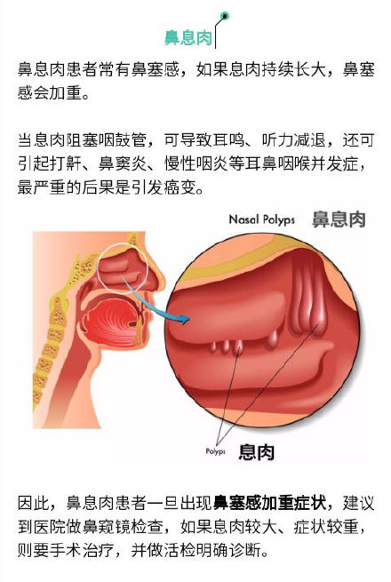 “息肉”離癌癥有多遠？腫瘤專家：這樣的最危險