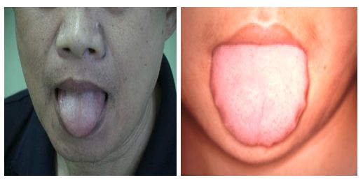 最容易被忽視的腫瘤征兆！如何提早發(fā)現？內附權威自測表